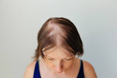 Entenda o que pode significar alopecia e como tratar