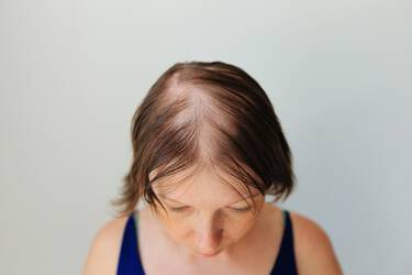 Mulher com alopecia