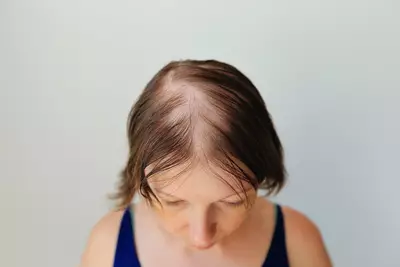Entenda o que pode significar alopecia e como tratar