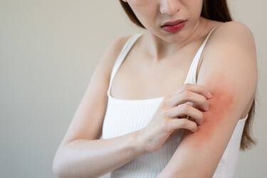 Mulher com alergia de ansiedade na pele