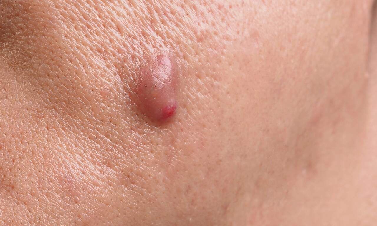 Acne conglobata