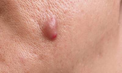 Acne conglobata