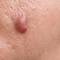 Acne conglobata