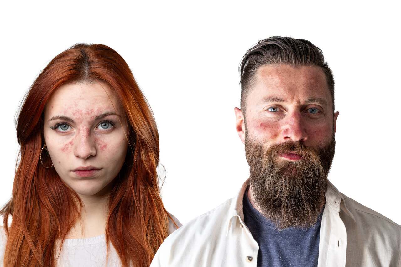 Exemplos de rosacea no rosto com vermelhidao e lesoes na pele