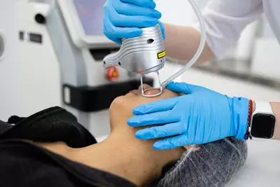 Mulher realizando procedimento de laser CO2 em uma clinica