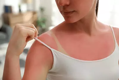 Foto de mulher com queimadura solar, ressaltando a importancia de se proteger do sol e tratar a pele queimada.
