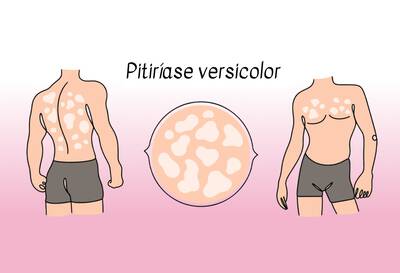 Imagem ilustrativa de pitiriase versicolor