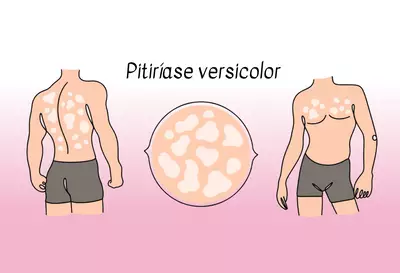 Imagem ilustrativa de pitiriase versicolor