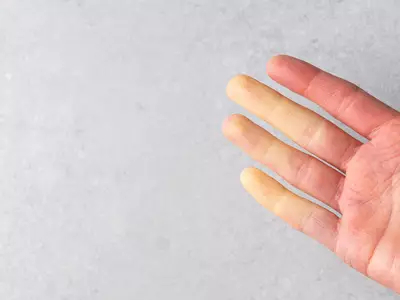 sintomas de esclerodermia - Fenomeno de Raynaud