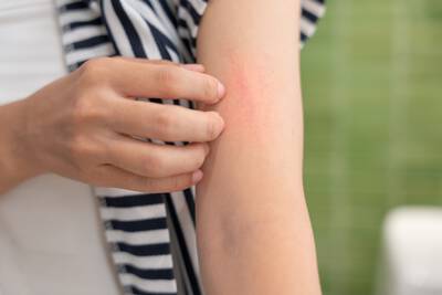 Foto de uma pele com micose, uma infeccao causada por fungos que pode afetar diferentes partes do corpo.