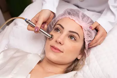 Foto do procedimento de peeling de diamante, um tratamento estetico para renovar e melhorar a textura da pele.