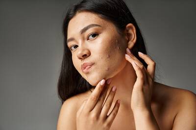 Rosto de mulher com espinhas e acne, um problema de pele comum que afeta a autoestima.