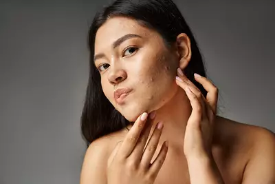 Rosto de mulher com espinhas e acne, um problema de pele comum que afeta a autoestima.
