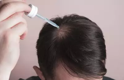 Homem usando minoxidil no cabelo
