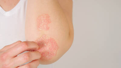 Foto de uma pele com psoriase, uma doenca inflamatoria cronica que causa descamacao e manchas na pele.