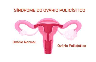 SOP - Sindrome do Ovario Policistico