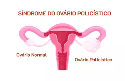 SOP - Sindrome do Ovario Policistico