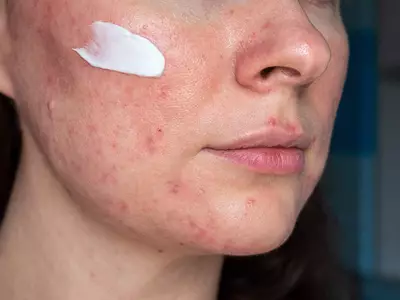 Mulher aplicando peroxido de benzoila no rosto com acne