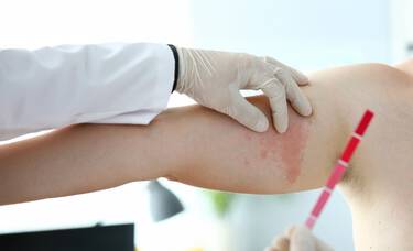 Medico avaliando mancha na pele devido a HIV