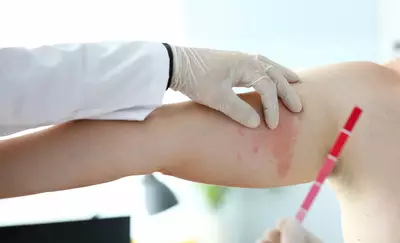 Foto de um braco com uma area de pele avermelhada e irritada, sendo examinada