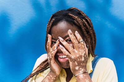 Pessoa com vitiligo