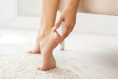 Pe com micose, uma infeccao fungica comum em areas umidas do corpo.