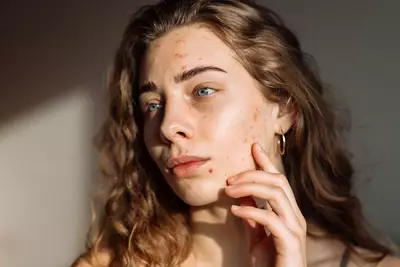 Pessoa com acne, entenda o mapa da acne no rosto