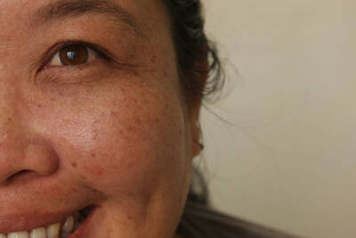 Pessoa com melasma no rosto