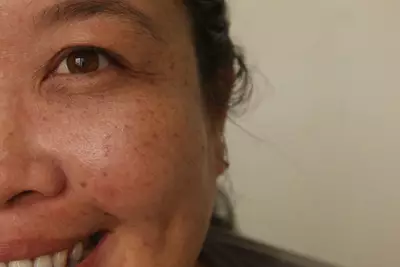 Pessoa com melasma no rosto