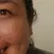 Pessoa com melasma no rosto