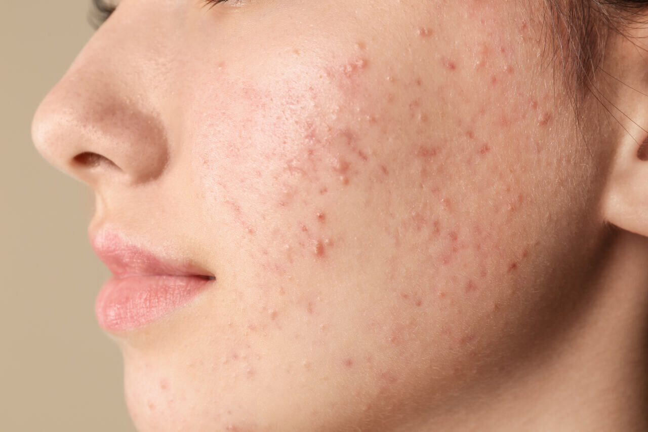 acne hormonal