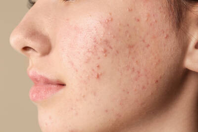 acne hormonal