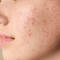 acne hormonal