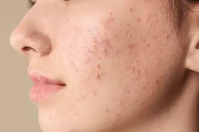acne hormonal