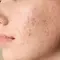 acne hormonal