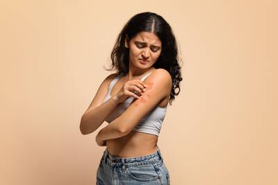 Modelo com dermatite, uma condicao inflamatoria da pele que causa vermelhidao, descamacao e coceira.