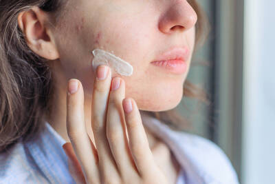 Jovem mulher fazendo tratamento para acne com receita caseira