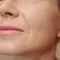 Foto de um rosto com bigode chines, uma condicao caracterizada por manchas escuras ao redor da boca.