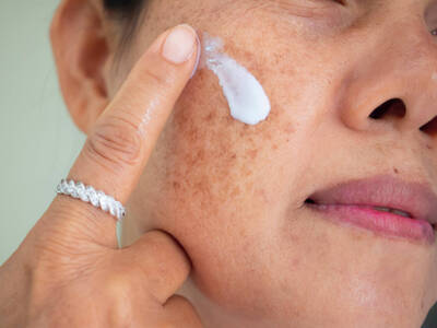 Mulher aplicando melhor pomada para melasma no rosto
