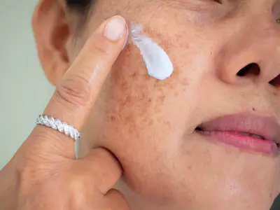 Mulher aplicando melhor pomada para melasma no rosto