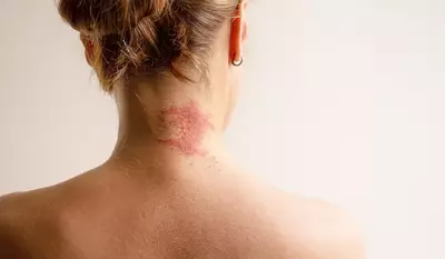 Irritacao e vermelhidao na nuca, comum em crises de dermatite atopica