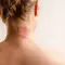 Irritacao e vermelhidao na nuca, comum em crises de dermatite atopica