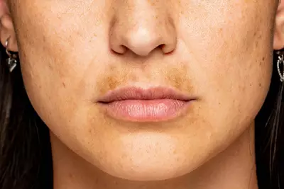 Mulher com manchas na pele