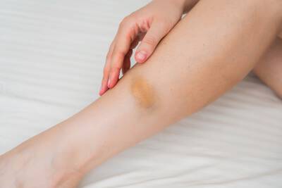 Como tirar o roxo da pele: guia completo para eliminar hematomas