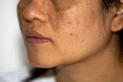 fotos de manchas escuras na pele de mulher