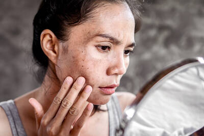 Mulher asiatica com manchas marrons na pele