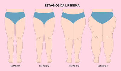 O que e lipedema