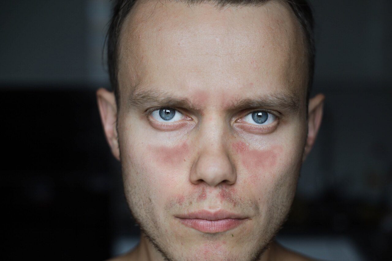 Homem com exantema no rosto devido a Lupus