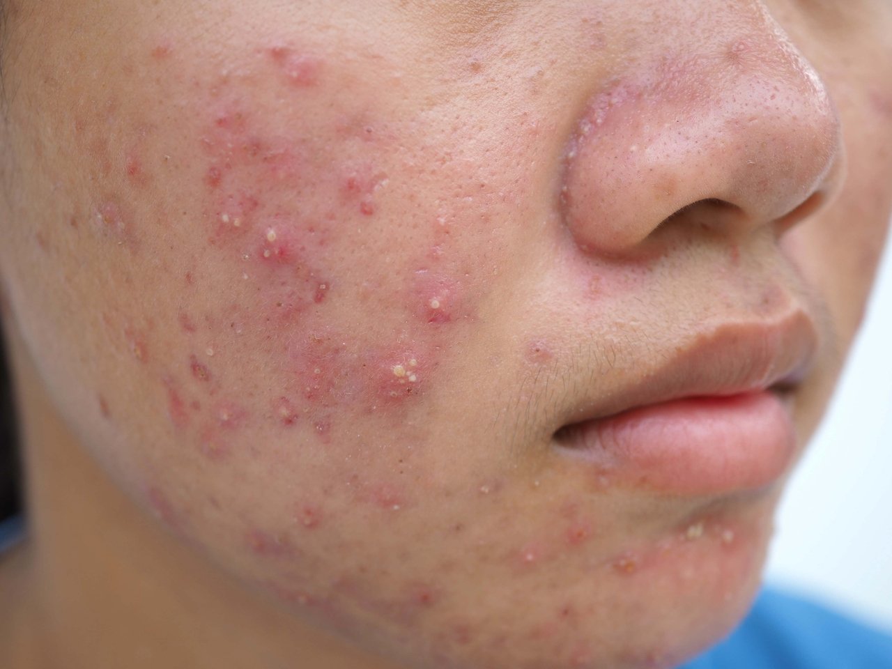 pessoa com acne cistica