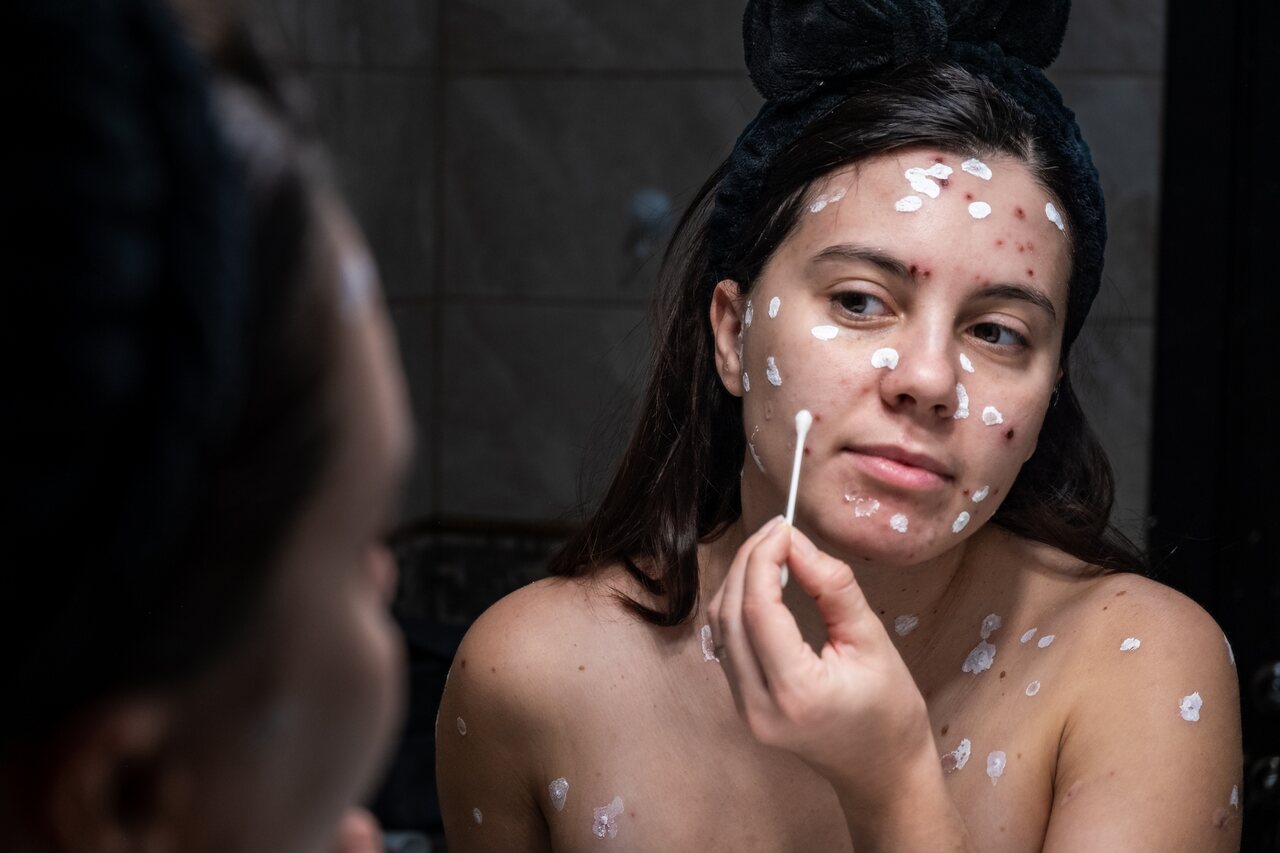 Mulher com catapora ou varicela